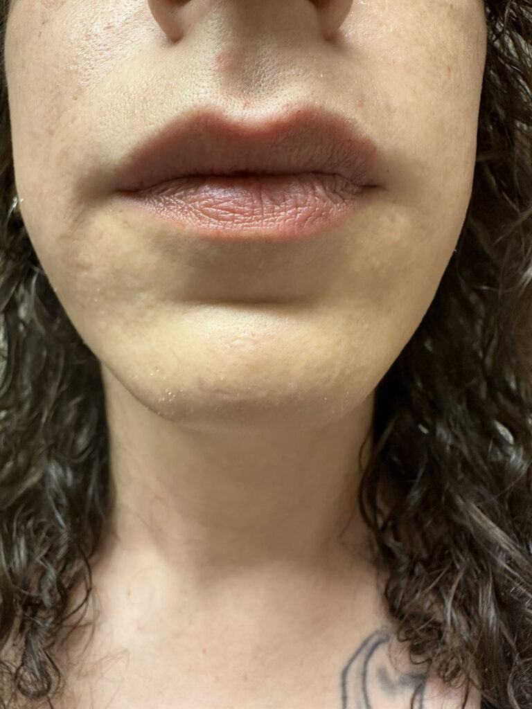 After Image: Transgender Facial Hair Removal - front