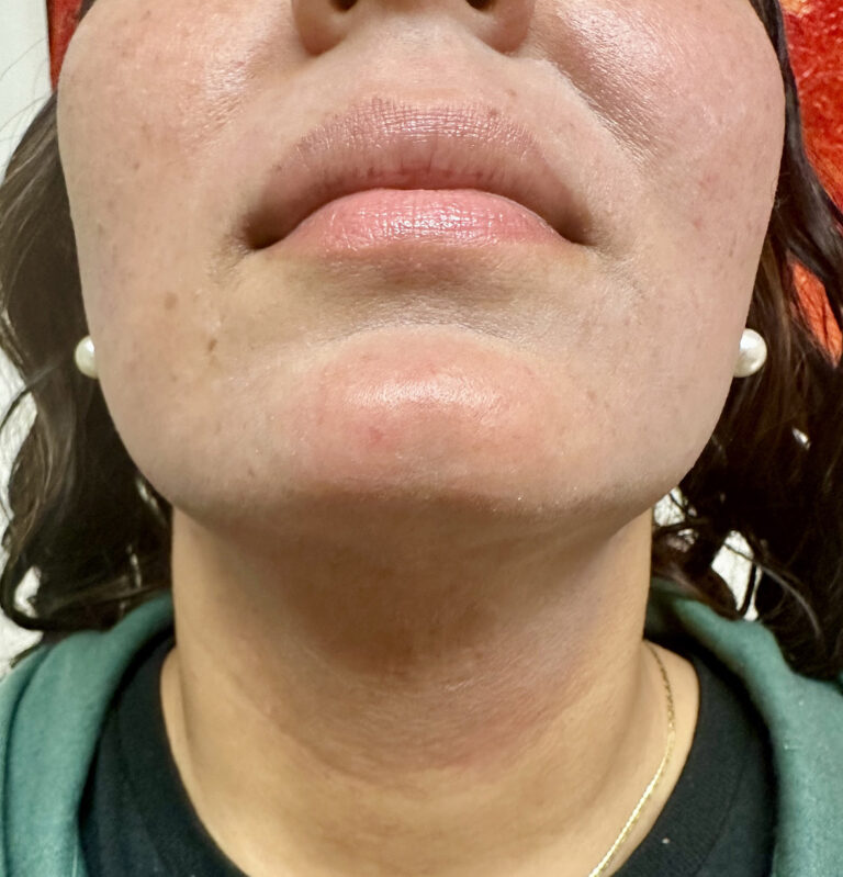 After Image: Female Facial Laser Hair Removal - front