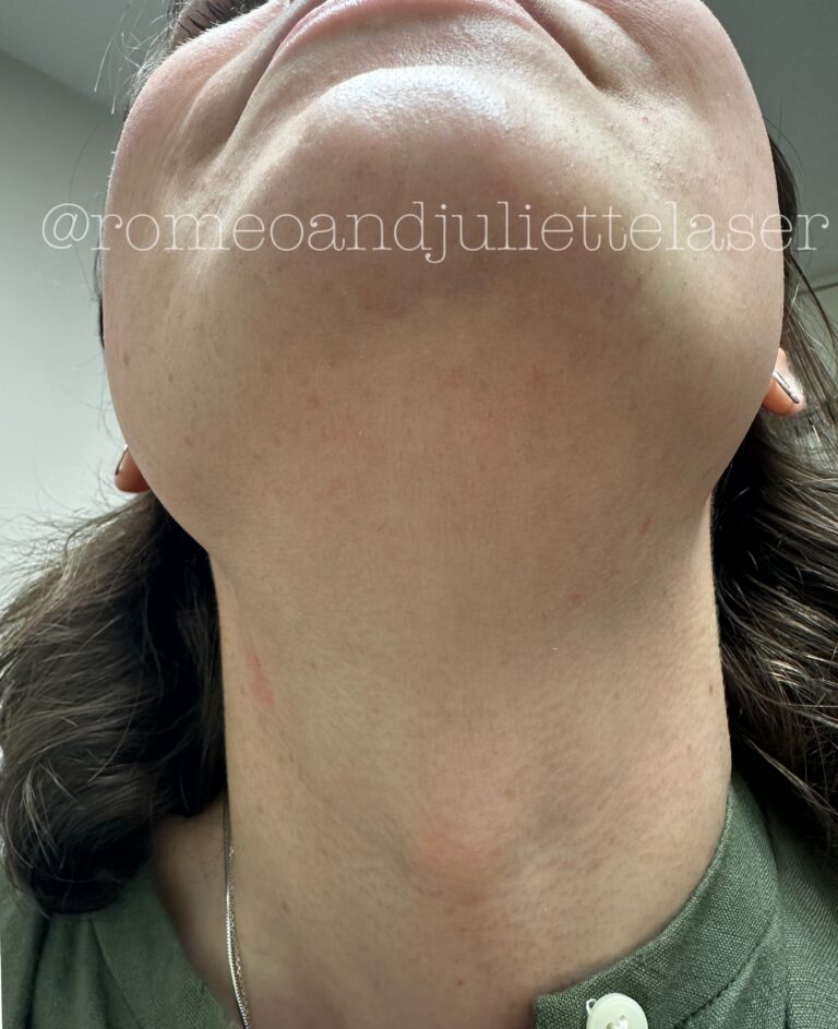 After Image: Transgender Facial Hair Removal - front