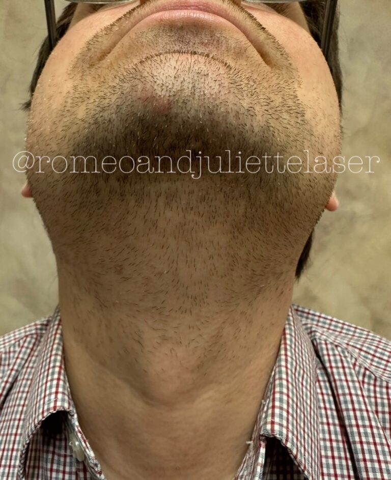 Before Image: Transgender Facial Hair Removal - front