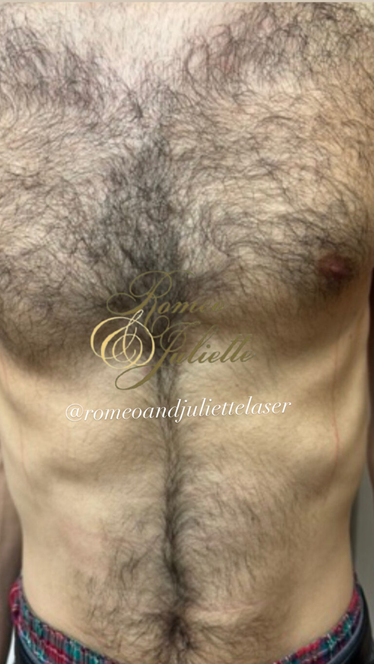 Before Image: Male Chest - front