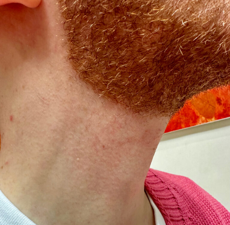 After Image: Red Facial Hair - front