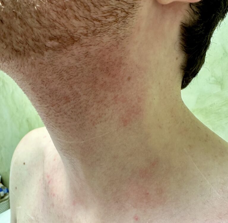 Before Image: Red Facial Hair - front